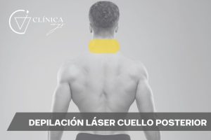 Depilación Láser Cuello Posterior