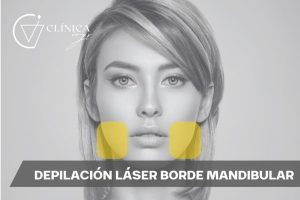 Depilación Láser Borde Mandibular