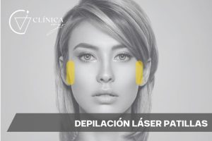 Depilación Láser Patillas