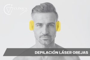 Depilación Láser Orejas