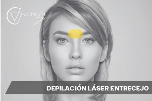 Depilación Láser Entrecejo