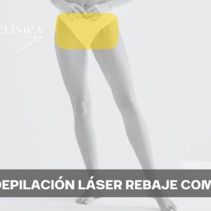 Depilación Láser Rebaje Completo