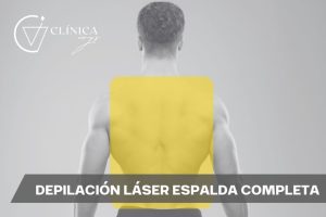 Depilación Láser Espalda Completa