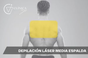 Depilación Láser Media Espalda