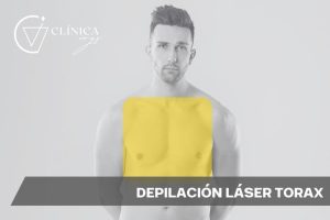 Depilación Láser Tórax